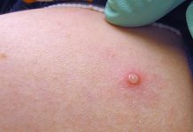 Mpox advisory issued to enhance screening at airports