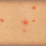 Chicken Pox
