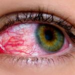 conjunctivitis
