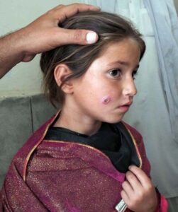 Leishmaniasis - a skin disfiguring infection surging in KP