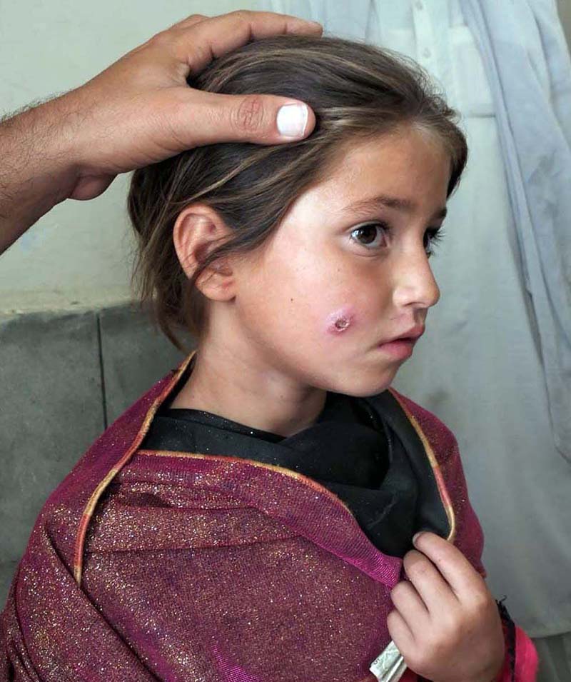 Leishmaniasis is a parasitic disease caused by a Leishmania parasite and exists in three forms including Cutaneous Leishmaniasis (CL), Visceral Leishmaniasis (VL) and Mucocutaneous Leishmaniasis (MCL), According to WHO, an estimated 700,000 to one million new CL cases occur annually around the globe while the disease affects some of the world’s poorest people and is associated with malnutrition, displacement, poor housing, weak immune system, climate change and lack of financial resources. Match a photo with APP feature Slugged “Leishmaniasis: a disfiguring skin infection surging in KP