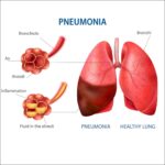 pneumonia