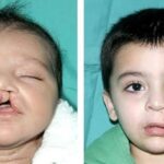 Cleft lip