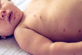 Measles claims lives of 5 children in Tando Allahyar
