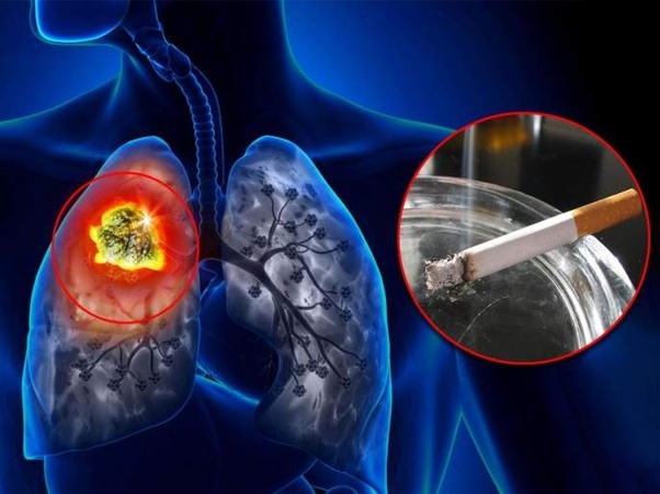 Tobacco smoke contains chemicals that cause cancer: Cardiologist