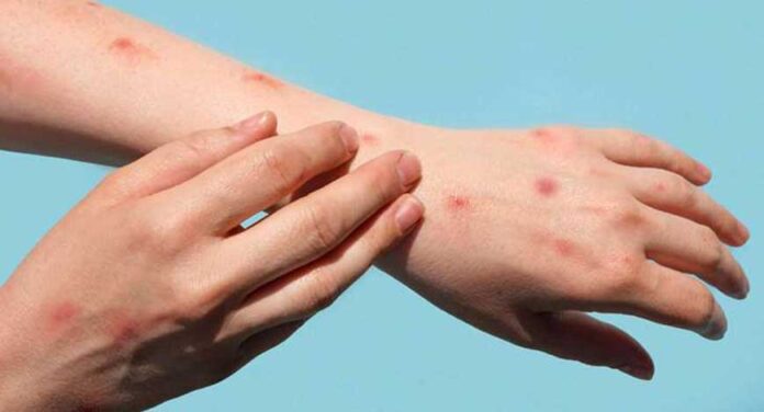 Mpox