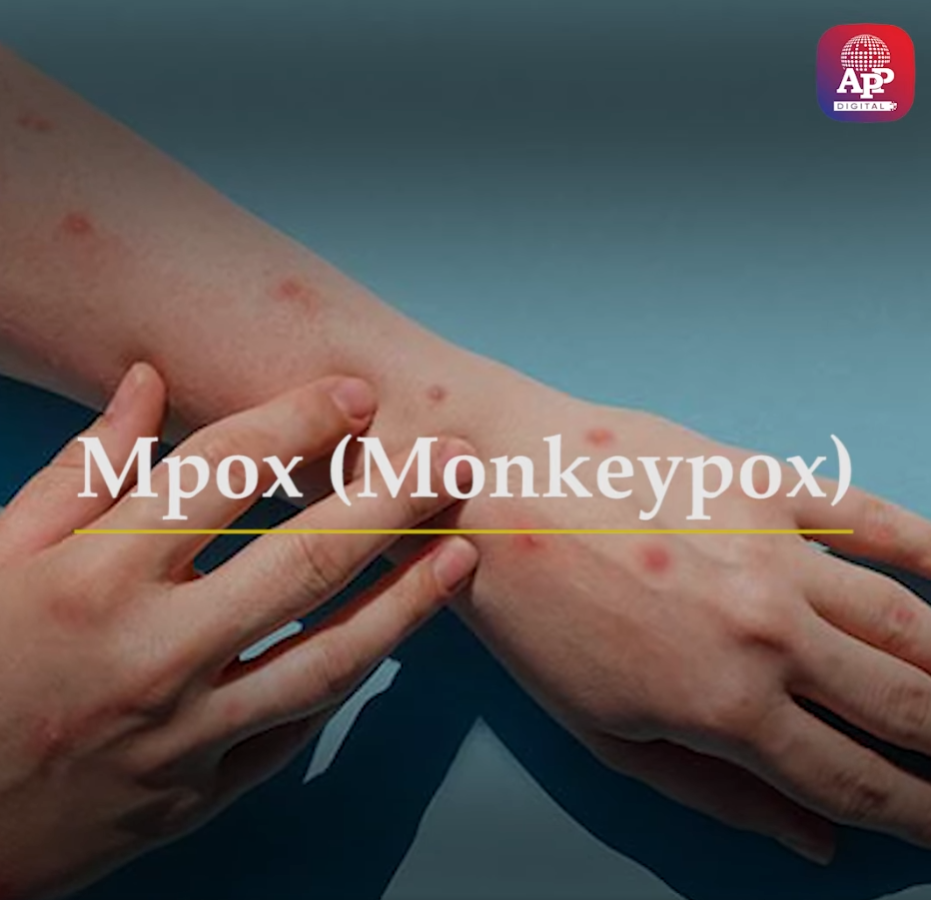 Check out Mpox (Monkeypox) Symptoms, Causes, Precautions, and Treatment