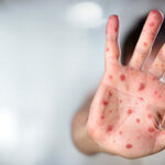 Two children die of measles in Thul