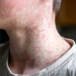 Media persons urged to play role in preventing Measles-Rubella diseases among children