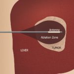 First successful Microwave Ablation for liver cancer performed in Quetta